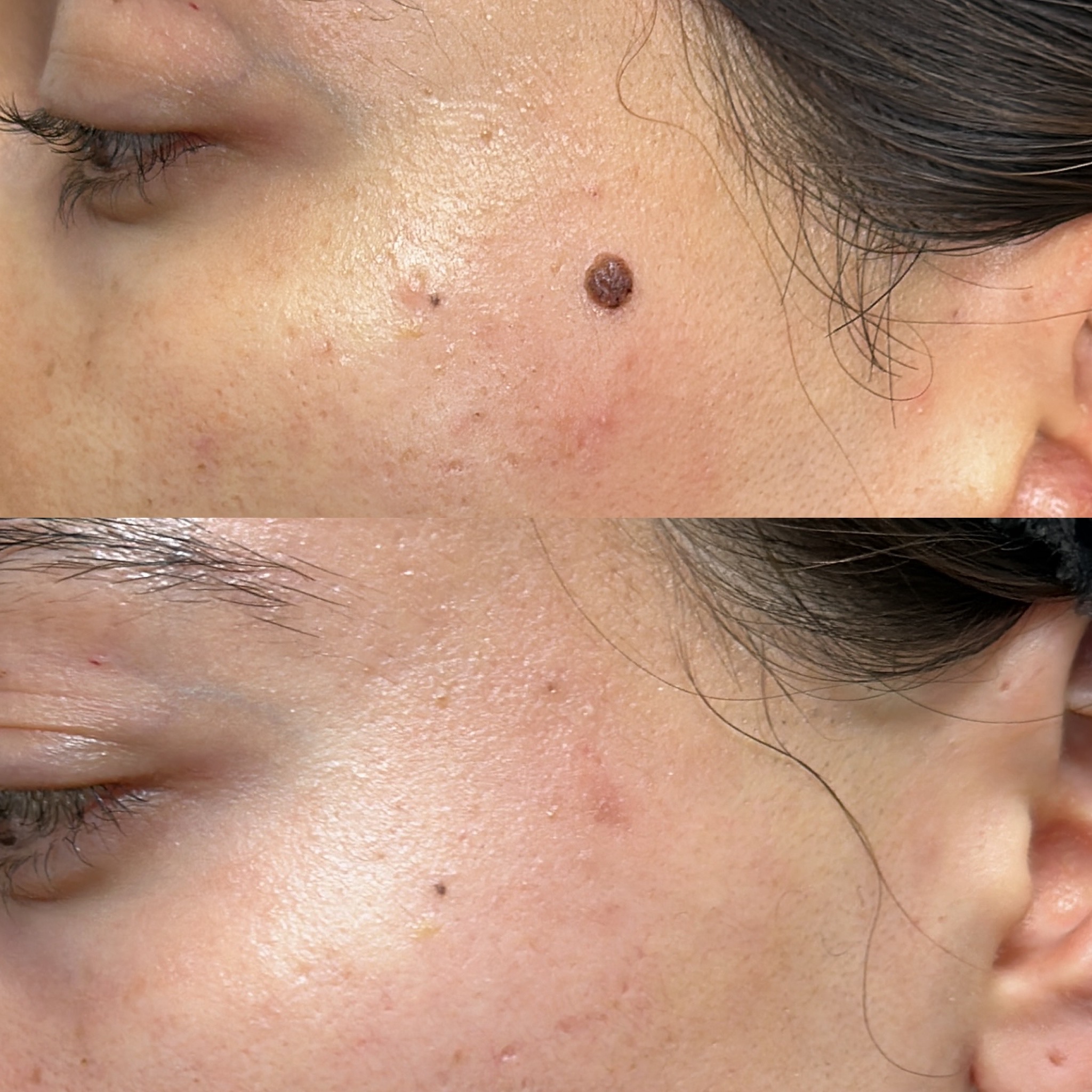 Secure Mole Elimination Approaches Mckinney, Tx Cryotherapy Medical Therapy