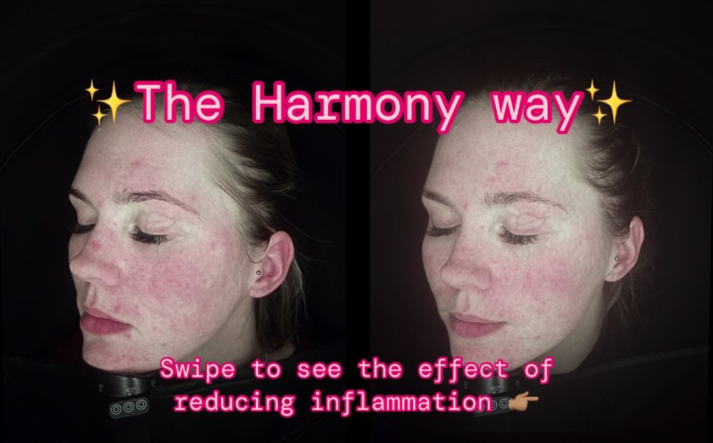 alt="So pleased for this lovely lady 💜 This person came to see us as she was struggling with her rosacea and wanted to reduce her reddness/inflammation before her wedding this summer. Were just over half way through her treatment but I couldn’t wait to show you her results 🥰 2 months between these photos show there’s no short cuts here, because you can’t cheat your way to good health! Stay tuned to see the final results 💛 This is Harmony, a combination of treatments tweaked for your needs on that particular day 🚀 Thank you for the chats & laughs, it’s fun whenever you’re in. The most chilled bride I’ve ever met! 📞07355 045597 📧 info@harmonymedical.uk #aesthetics #skin #rosacea #health #weddingprep #inflammation"