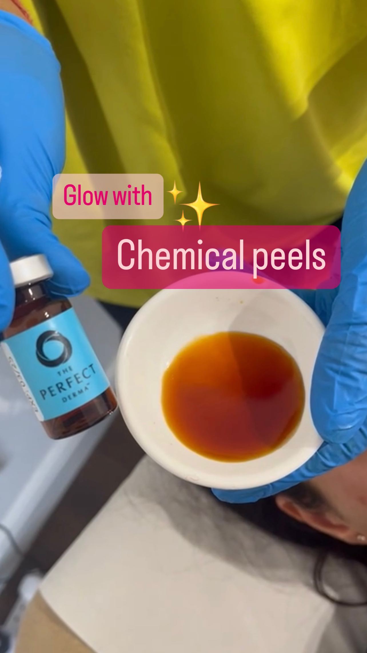 Are you interested in chemical peels? They exfoliate your skin to treat acne, hyperpigmentation, fine lines, and uneven tone, revealing a smoother, more radiant complexion. Chemical peels come in different types, like glycolic, salicylic, and lactic acid, each tailored to various skin needs. Suitable for most people, they can also be used on body areas like the back to combat back acne. Ready to glow? Book your appointment at Harmony Clinic today. info@harmonymedical.uk 07355 045597 #ChemicalPeel #Skincare #GlowUp #HarmonyClinic #SkinCareTreatment #healthyskin