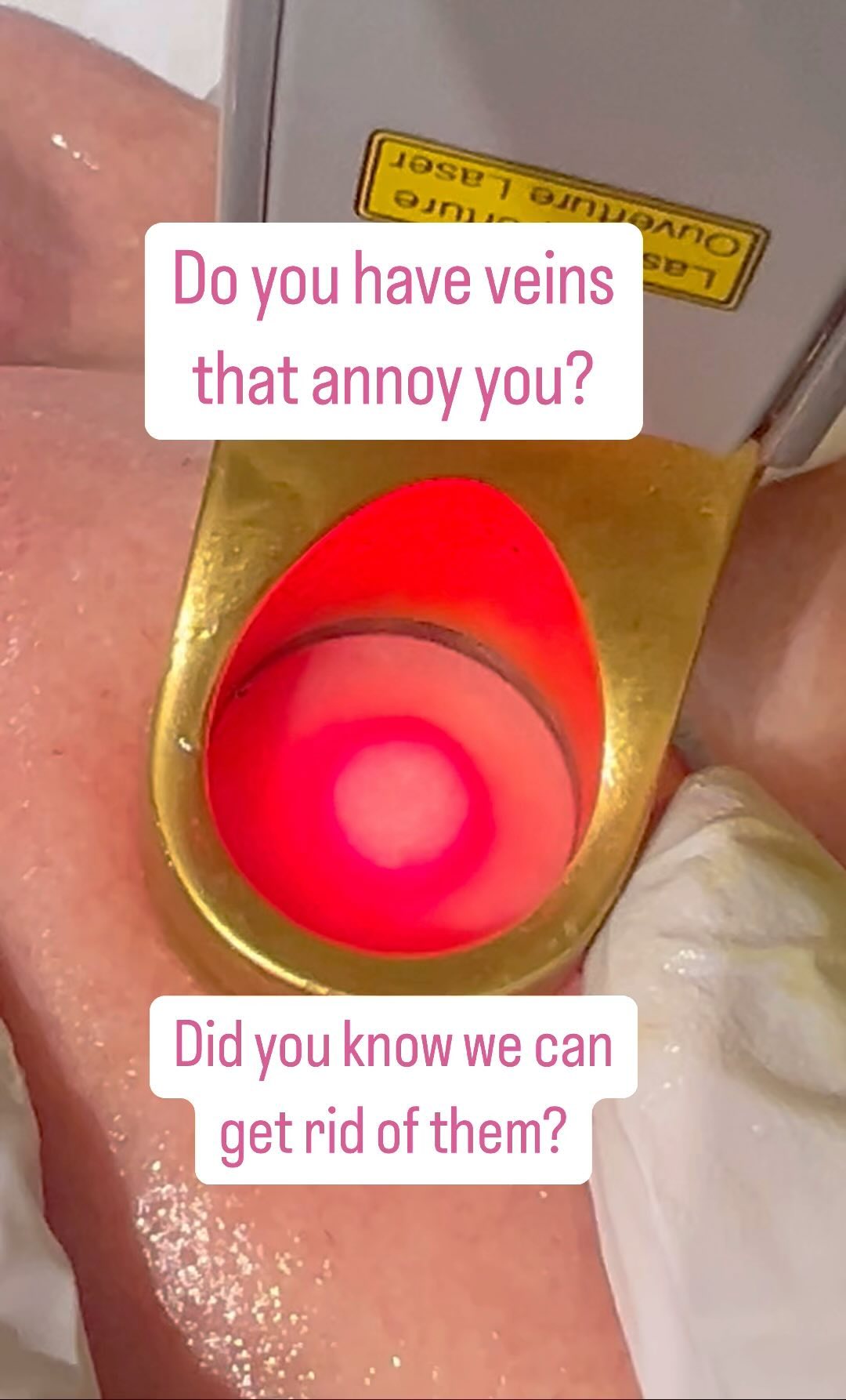 Did you know we can get rid of those tiny, thread like veins that have been bothering you? Otherwise referred to as spider veins, broken capillaries or telangiectasias. This is a quick, comfortable procedure where we use a special laser (yes, another type of laser) to get rid of those pesky thin veins 🪄. You may need 1-3 sessions, depending on the size or location. I.e a leg vein is typically trickier to get rid of, so is likely to need more sessions. Interested? Drop us a message 💜 📞 07355 045597 📧 info@harmonymedical@l.uk #spiderveins #threadveins #aesthetic #laser #rejuvenation